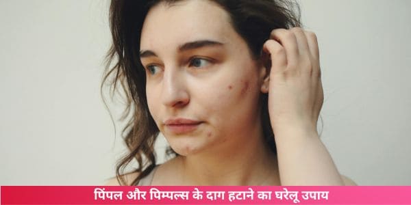 फेस पर पिंपल कैसे हटाए